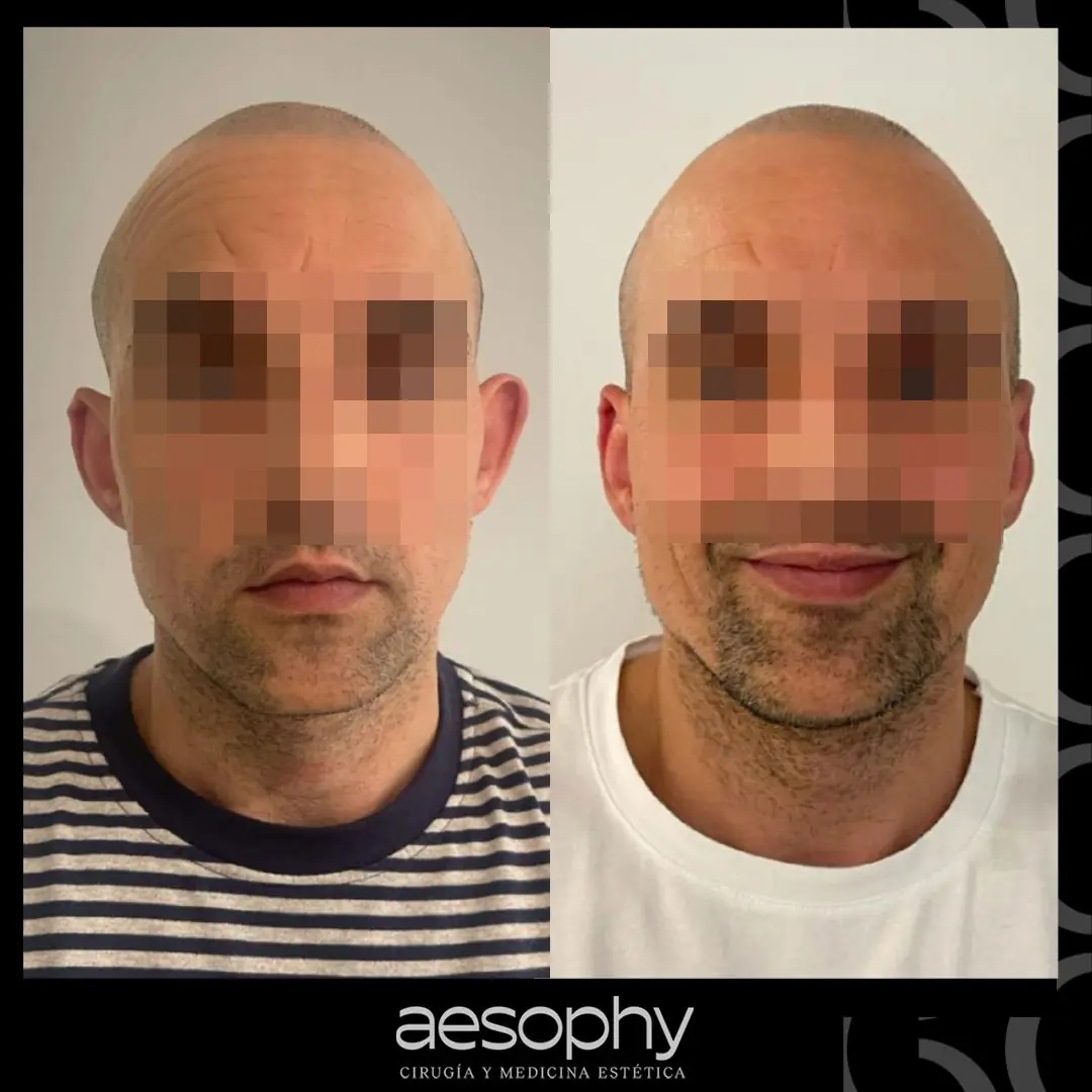 Otoplastia Málaga: Transforma tus Orejas con Cirujanos Expertos en Clínica Aesophy