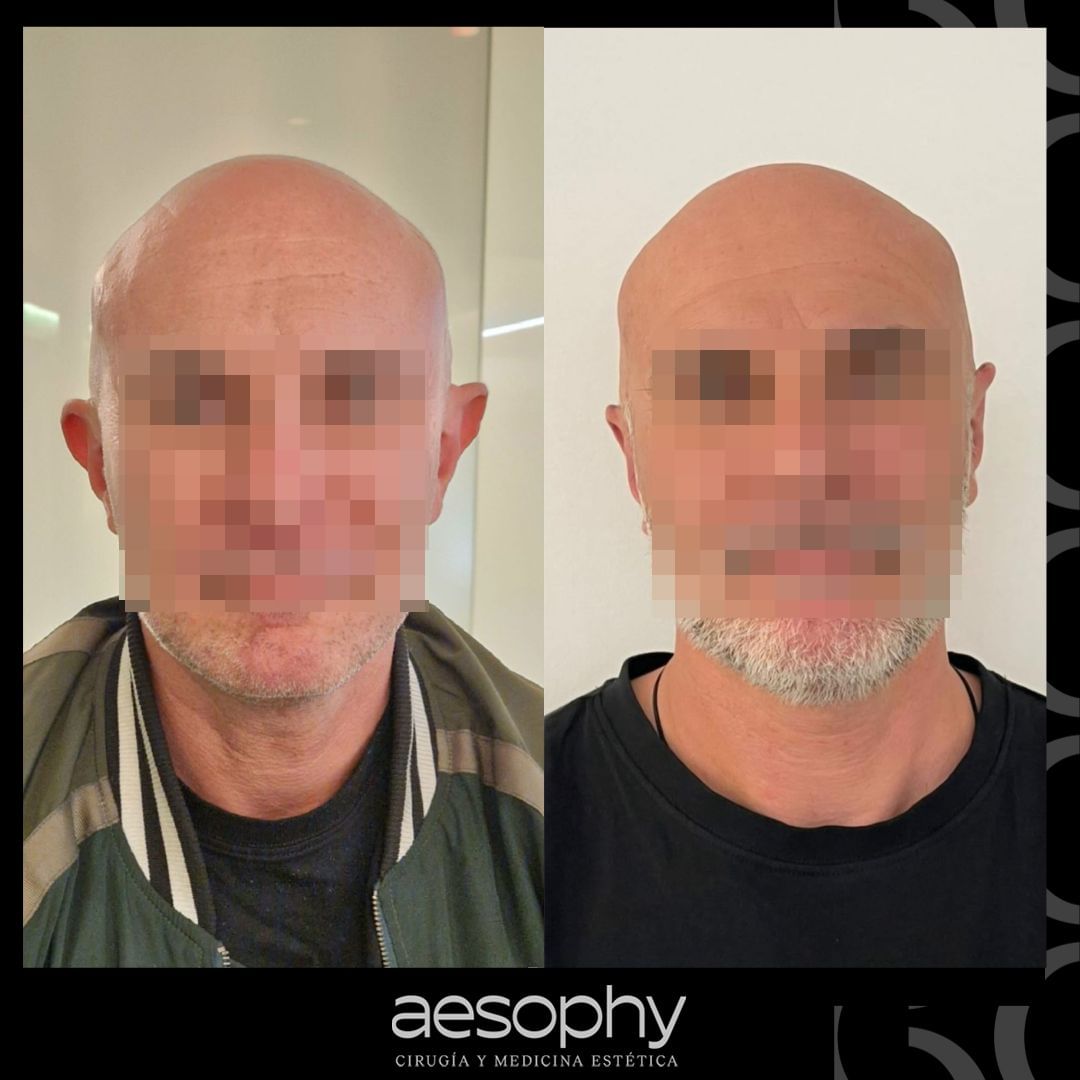 Otoplastia Málaga: Transforma tus Orejas con Cirujanos Expertos en Clínica Aesophy