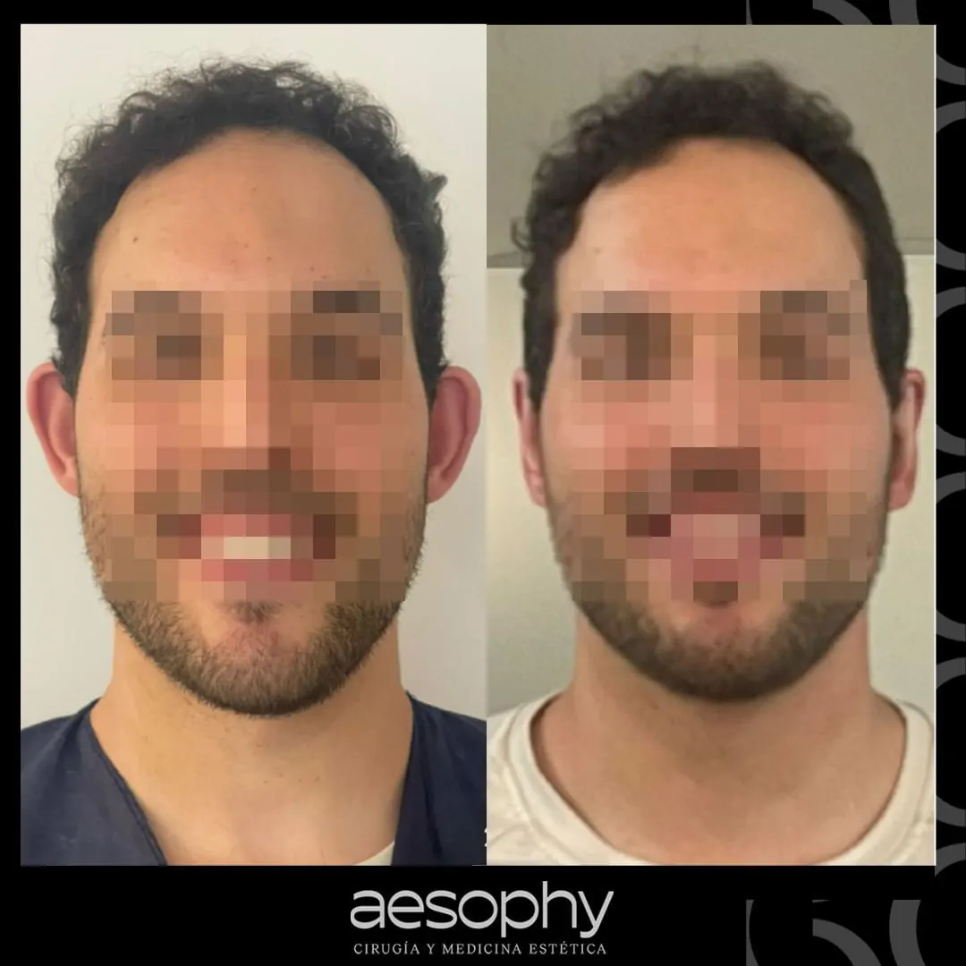 Otoplastia Málaga: Transforma tus Orejas con Cirujanos Expertos en Clínica Aesophy
